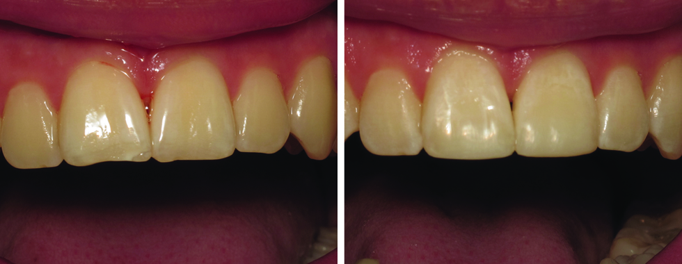 Composite repair of discolored and worn central incisors. (NOT full veneers).