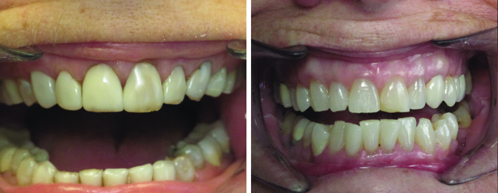 Crowns/Composite repairs