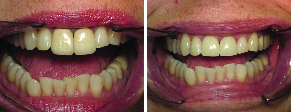 Remaking older, oversized crowns, and improving the shade