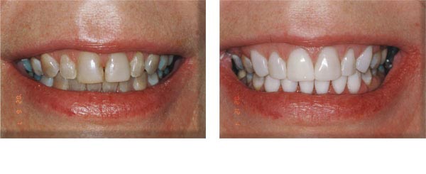 Badly discolored teeth treated with composite veneers.