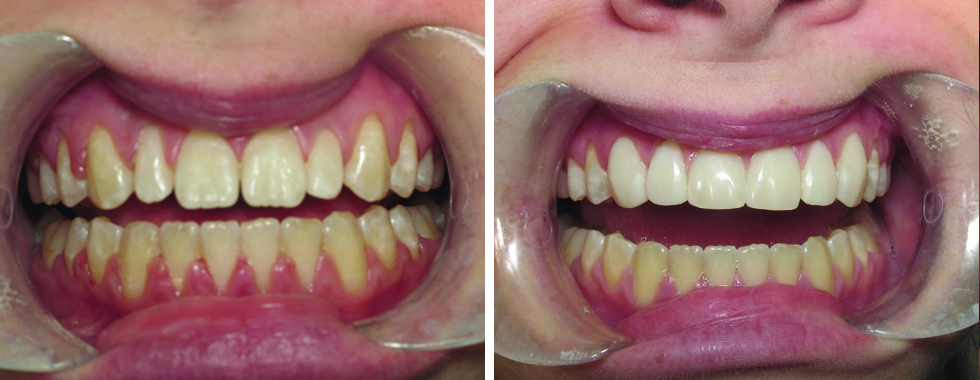 Cosmetic bonding for "small" teeth