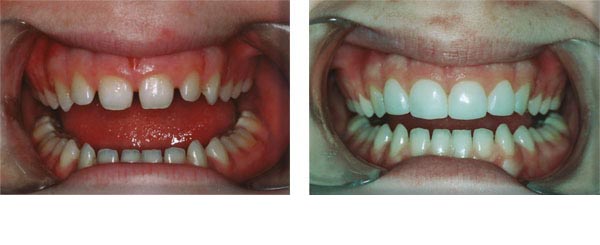 Closed spaces, and turned 'small' teeth into normal sized teeth.