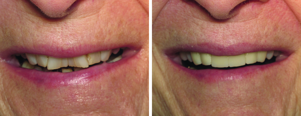 Badly worn and crooked incisors